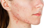 woman's face with acne